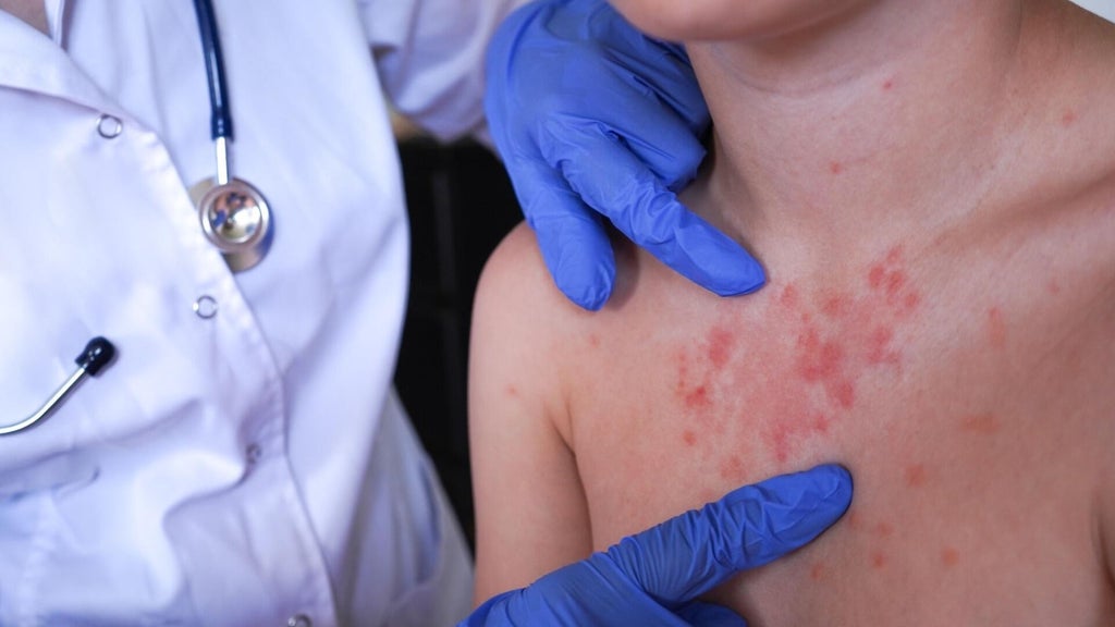 Minnesota's 80 measles cases this year are the most since 1990, health officials say — Shorewood Health news