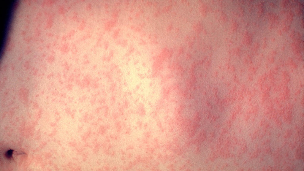 25 cases of measles identified in central, southeastern Minnesota, MDH says — WCCO / CBS Minnesota, Shorewood Health news