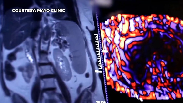 Healthy SA: Battling liver cancer, a disease which often has no symptoms early on — KENS 5 (San Antonio), Shorewood Health news